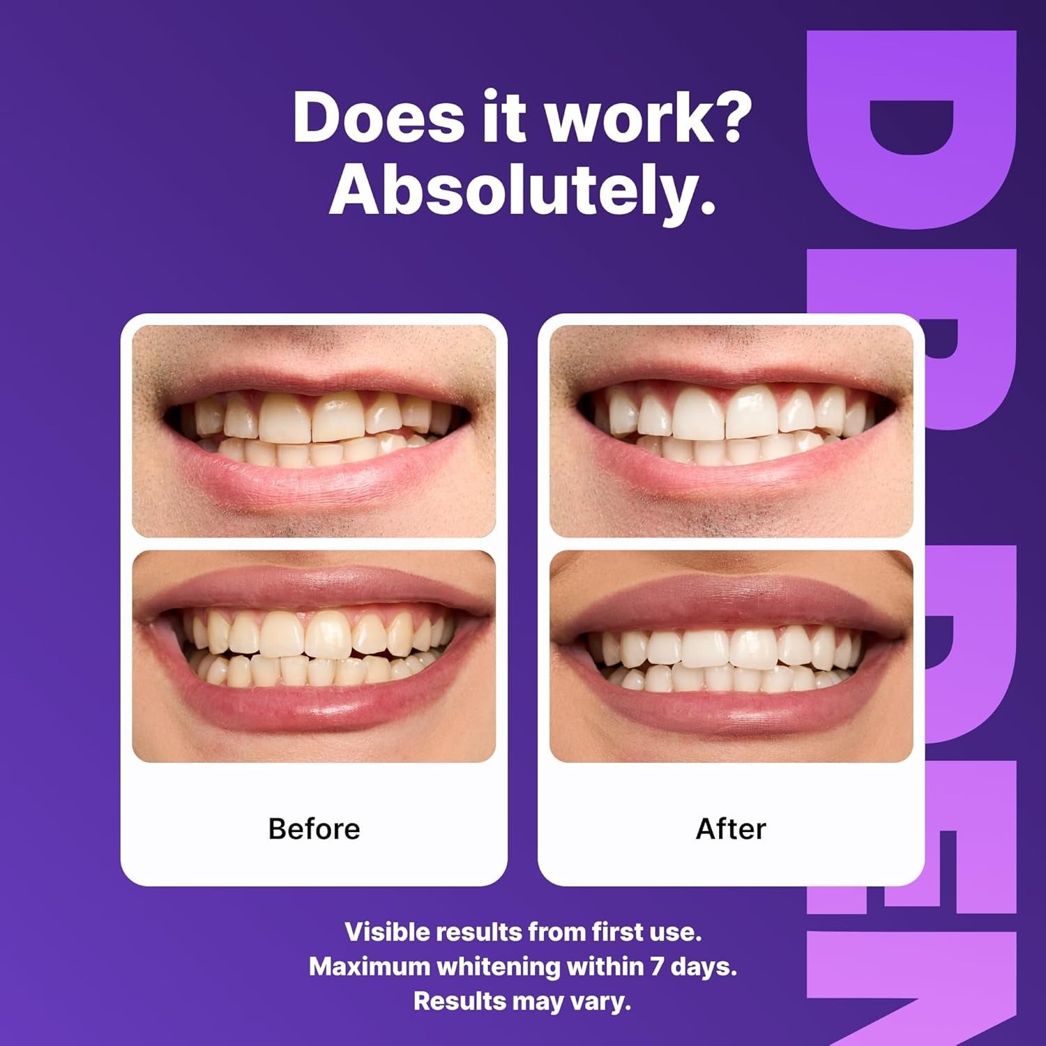 Dr.Dent Purple Teeth Whitening Strips ( 2nd Generation - Advanced Technology )