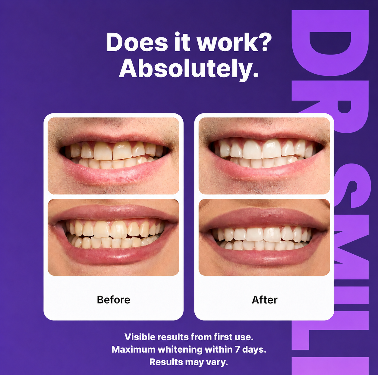 Dr.Smile Purple Teeth Whitening Strips ( 2nd Generation - Advanced Technology )